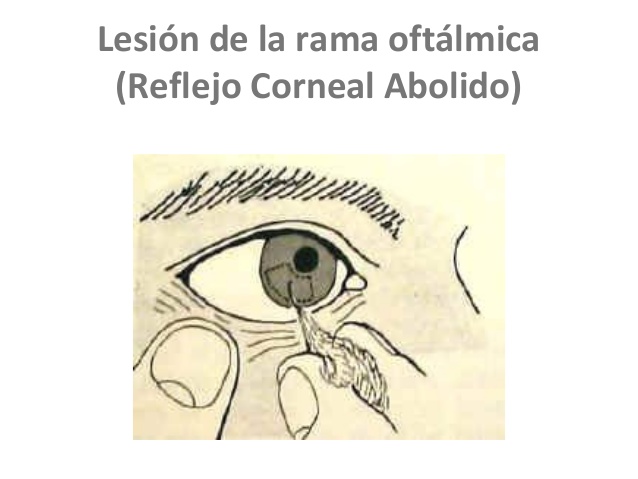 Reflejo corneal.
