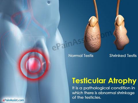 Atrofia testicular.
